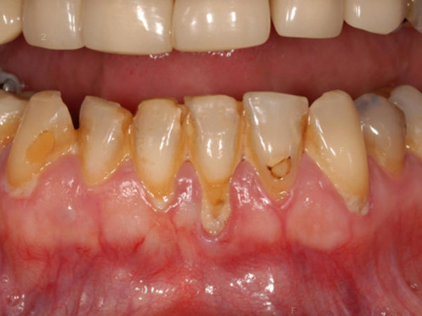 nih_160314_periodontal_disease_800x600.jpg