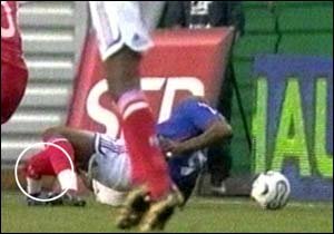 Cisse\'s broken_leg.jpg